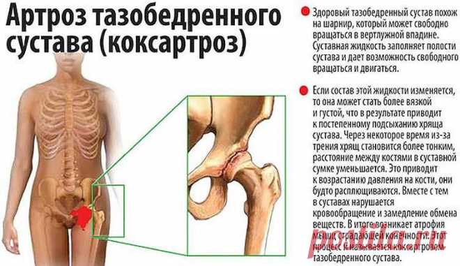 Бугун артрозни даволашда бир қанча муолажа усуллари жорий қилинган.