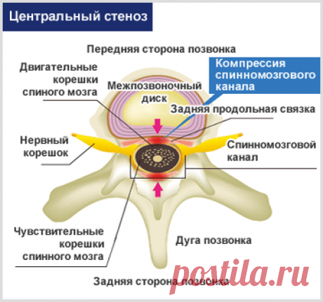 Симптомы стеноза позвоночного канала | International Lumbago Clinic | Дзен