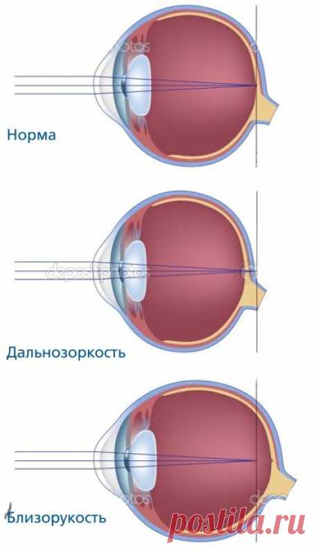 Нарушения зрения: близорукость, дальнозоркость, астигматизм, пресбиопия. Причины ухудшения и ослабления зрения