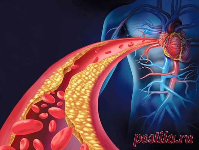 Как почистить закупоренные артерии с помощью питания Артерии являются основой кровеносной системы, переносят кровь от сердца к внутренним органам, головному мозгу человека.