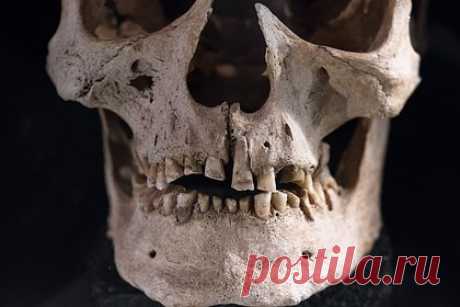 У викингов из Швеции обнаружили кариес. Ученые Университета Гетеборга в Швеции обнаружили, что викинги часто страдали от болезней зубов и пытались их лечить. Были обнаружены следы кариеса и зубных инфекций у 171 человека, похороненного в Варнхеме в X — XII веках. Викинги ковырялись в зубах, чтобы удалить остатки пищи, а для облегчения боли подпиливали их.