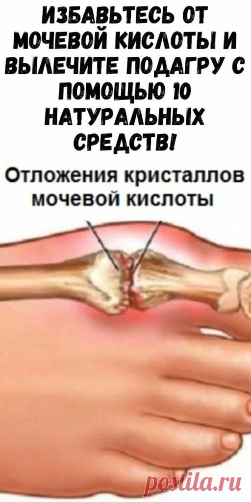 Избавьтесь от мочевой кислоты и вылечите подагру с помощью 10 натураль ...