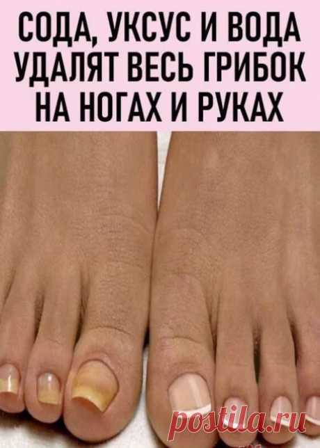СОДА, УКСУС И ВОДА УДАЛЯТ ГРИБОК НА НОГАХ И РУКАХ..