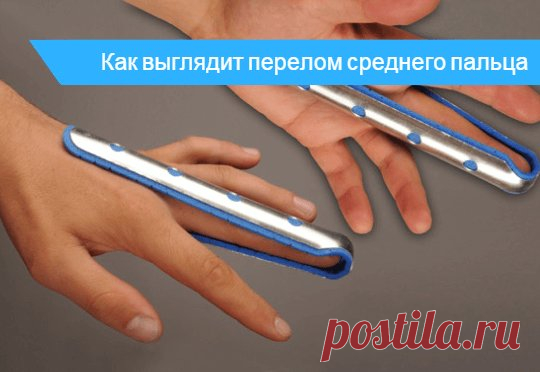 Как восстановить палец после. Перелом среднего пальца на руке. Как выглядит перелом среднего пальца. Больничный при переломе пальца. Перелом мизинца на руке фиксация.