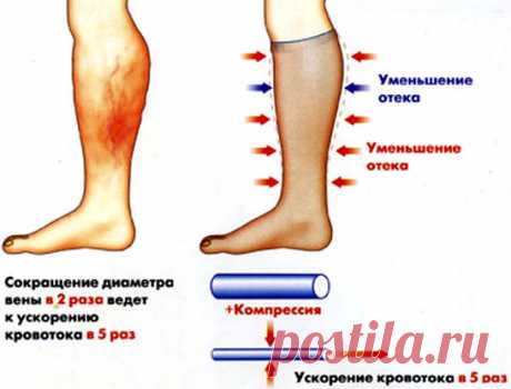 Лимфостаз нижних конечностей — медикаментозная терапия + лечение в домашних условиях