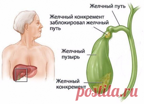 Застой желчи: лечение и профилактика
