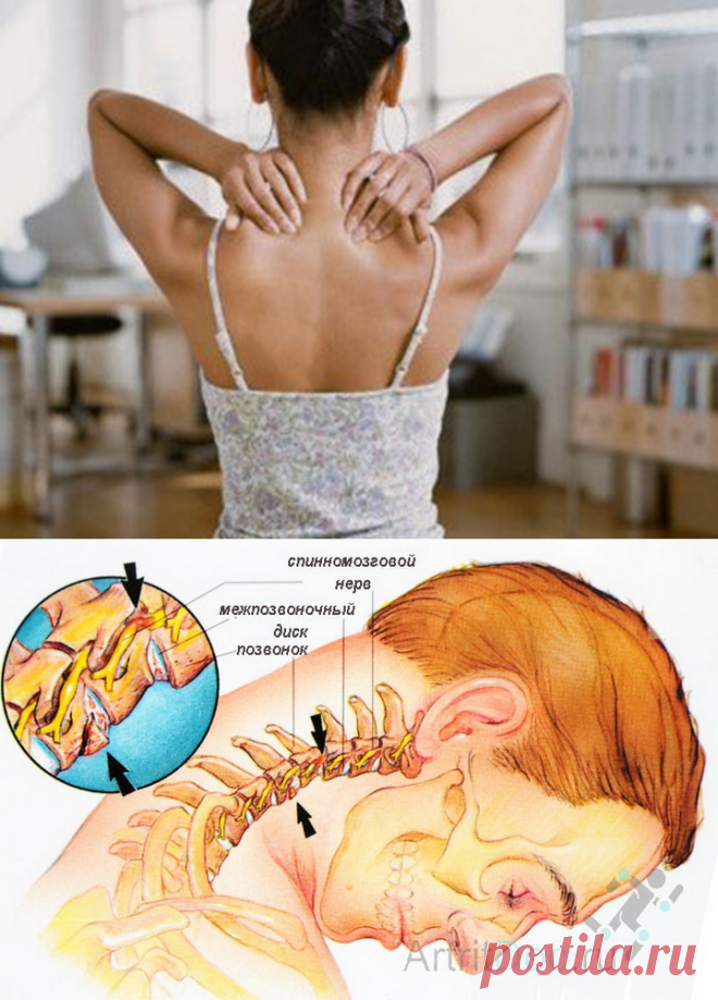 Обострение шейного остеохондроза лечение в домашних. Шейный остеохондроз. Шея при остеохондрозе. Массаж шейного отдела позвоночника. Остеохондроз шейного отдела позвоночника.