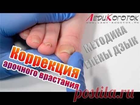 ВРОСШИЙ НОГОТЬ, АРОЧНАЯ ФОРМА, КАК ВЫЛЕЧИТЬ, [Методика Елены Дзык]