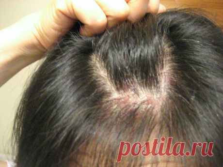 Лечение псориаза на голове в домашних условиях. Классические схемы лечения, домашние средства, народные методы лечения псориаза головы.