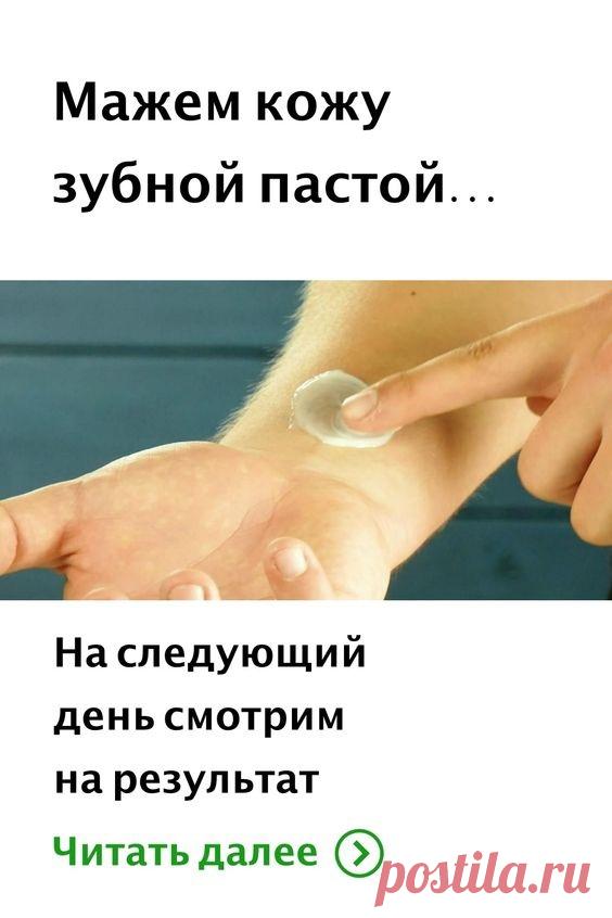 зубная паста от синяков под глазами. зубная паста от ожогов. убирание прыщей зубной пастой. зубная паста от фингала под глазом. метрогил дента гель после имплантации.