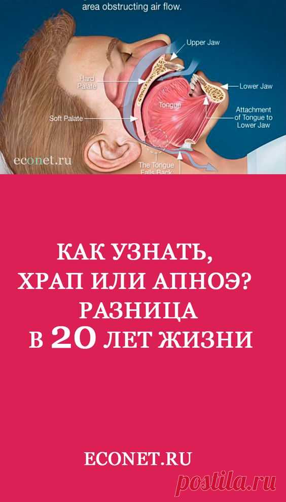 Как узнать, храп или апноэ? Разница в 20 лет жизни

✅ХРАП страшен как предвестник и один из основных симптомов апноэ. 20% людей после 30 лет постоянно храпят, а от АПНОЭ страдают от 2 до 5% взрослых, так что приблизительно каждый пятый храпун – в опасности. За храпом маскируется патология, которая может реально уменьшить жизнь человека на 15-20 лет.