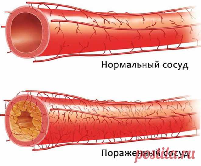 Старое немецкое средство поможет быстро очистить артерии и укрепить организм