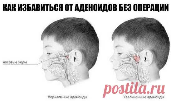 Как избавиться от аденоидов без операции?
Мы так спаслись от операции (аденоидит, 2-я степень, постоянные насморки и, как следствие, кашель): операция была под вопросом, поехали в Питер (детская ЛОКБ) к Лору-хирургу Медведеву, он решил не торопиться со скальпелем. Схема лечения на две недели измениля картину в корне: и так, капаем в нос простой Нафтизин по 2 капли в каждую ноздрю, то есть открыва