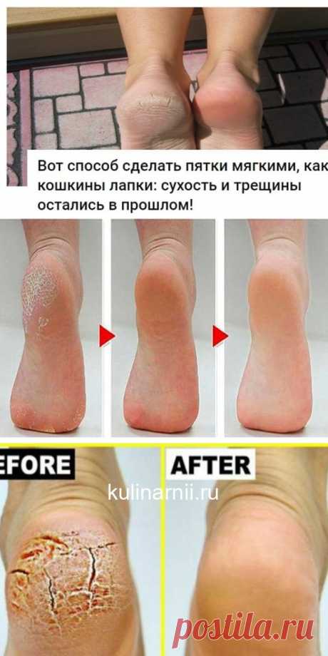 Вот способ сделать пятки мягкими, как кошкины лапки: сухость и трещины остались в прошлом!