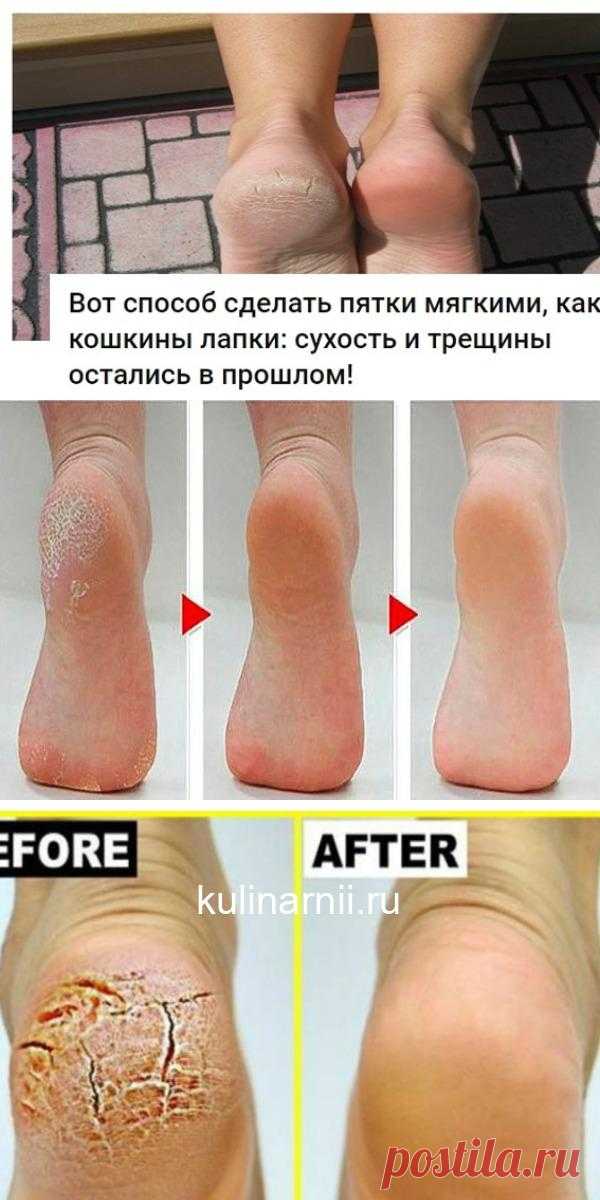 Вот способ сделать пятки мягкими, как кошкины лапки: сухость и трещины остались в прошлом!
