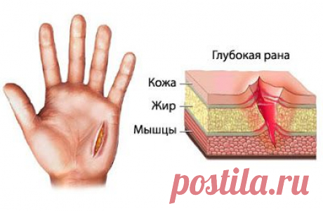 ЛЕЧЕНИЕ РАН, ПРОФИЛАКТИКА ЗАРАЖЕНИЯ ОРГАНИЗМА