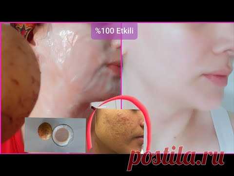НАНЕСИТЕ КАРТОФЕЛЬ НА ЛИЦО ТАКИМ ОБРАЗОМ ДЛЯ ФАРФОРОВОЙ КОЖИ, СУПЕР ЭФФЕКТ!