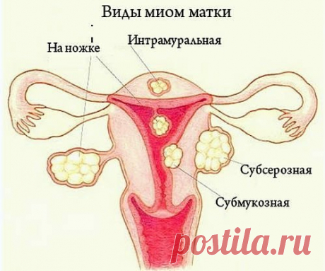 Миома

&quot;Хочу рассказать, как я вылечила миому матки. Это было давно, но не хочется, чтобы рецепт остался в забвении. Я жила тогда в Киргизии, во Фрунзе, и дала мне его молодая врач-гинеколог по имени Чинара из поликлиники № 2 при роддоме № 1.

Вот рецепт:
Показать полностью…