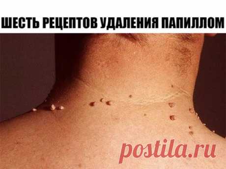 ШЕСТЬ РЕЦЕПТОВ УДАЛЕНИЯ ПАПИЛЛОМ
Первый рецепт.
Для избавления от папиллом в домашних условиях рекомендуется использовать порошок, приготовленный из хорошо просушенных семян расторопши, благотворно действующего на организм в целом. Данный порошок следует принимать по одной чайной ложечке трижды – четырежды в день, запивая его водой. При этом до приёма пищи с момента приёма должно пройти не менее двух часов.
Второй рецепт.
Одним из самых эффективных популярных наружных домашних средств против