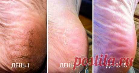 Первоклассное средство против трещин на пятках Трещины на пятках возникают в результате неправильного ухода за ногами, нехватки витаминов, ношения неудобной обуви, а также вследствие нарушения обмена веществ. Этот дефект доставляет массу неудобств…