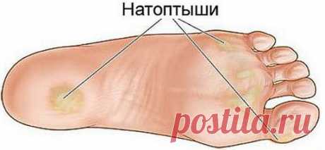 Как быстро вылечить мозоль: несколько простых и эффективных способов