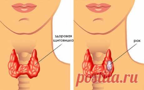 Симптомы заболевания щитовидной железы у женщин после 30, 40, 50 лет. Первые признаки, лечение народными средствами и медикаментозное