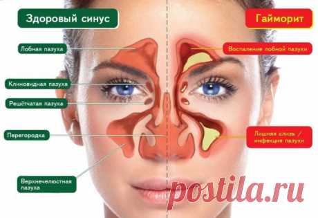 Советы при лечении гайморита.