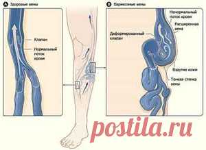 Что делать при варикозном расширении вен? часть 2