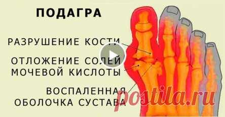 Удали мочевую кислоту из вашего тела и предотврати подагру и боли в суставах!Применяй 5 супер эффективных средств!