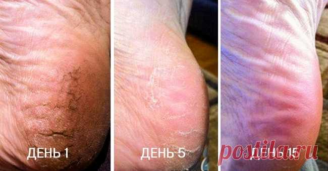 Первоклассное средство против трещин на пятках: смешай 2 ингредиента и забудь о проблеме! Трещины на пятках возникают в результате неправильного ухода за ногами, нехватки витаминов, ношения неудобной обуви, а также вследствие нарушения обмена веществ. Этот дефект доставляет массу неудобств…