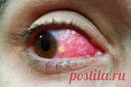 На глазном яблоке желтое пятно, точки (на белке, возле зрачка): причины появления, диагностика, лечение выпуклого образования, профилактика, фото