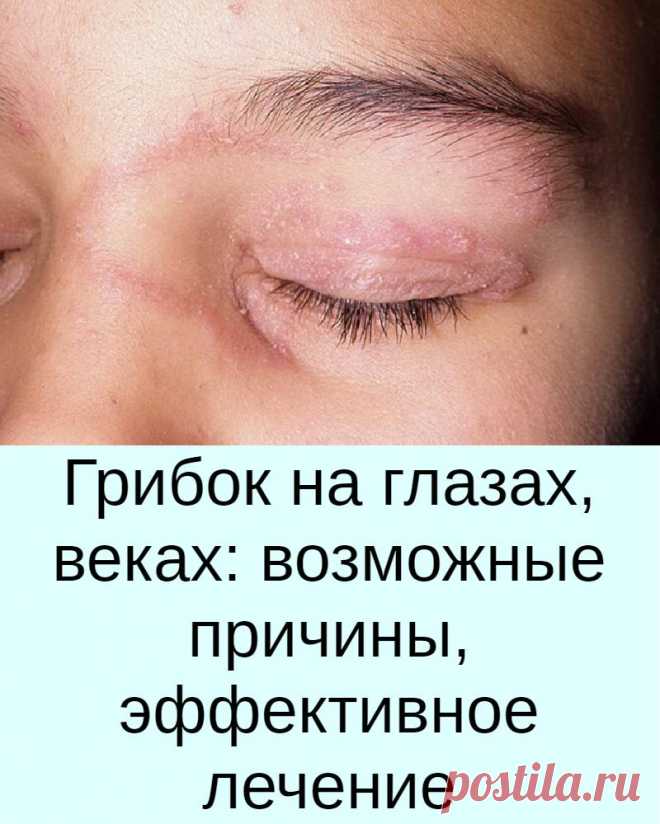 Грибок на глазах, веках: возможные причины, эффективное лечение ...