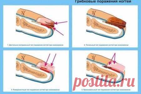 Как вылечить грибок на ногтях?