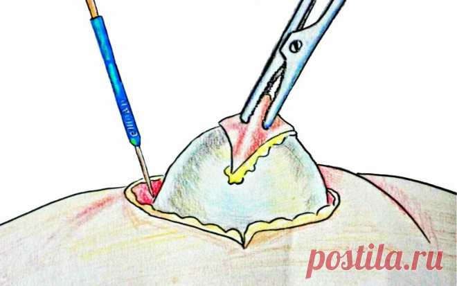 Не рваться к ножу хирурга: вывести жировик поможет тонкая пленка под скорлупой куриного яйца