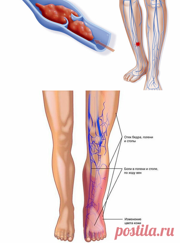 Тромб в сосудах нижних