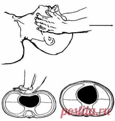 Классическая сердечно-легочная реанимация (КСЛР) или реанимация АВС (CRP) / КАППО.Японская техника реанимации в практике боевых искусств