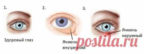 Ячмень на глазу. Что делать, как лечить? | Семья и ребенок