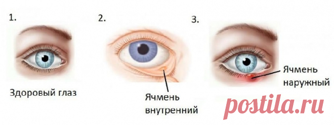 Ячмень на глазу. Что делать, как лечить? | Семья и ребенок