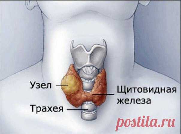 ЛЕЧИМ УЗЕЛ НА ЩИТОВИДНОЙ ЖЕЛЕЗЕ