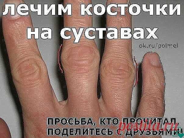 *ПОЛЕЗНЫЕ СОВЕТЫ ИЗ БАБУШКИНОЙ ШКАТУЛКИ* Лечим косточки на суставах Зрелище — не из приятных. Увидела мои руки знакомая и обрадовала: «Не переживай. У меня были такие же. Я от них избавилась довольно быстро.» И она поделилась рецептом. Я проделала 10 процедур, и мои наросты стали меньше. Оказывается, таким образом можно избавиться и от «косточек» на ногах! А рецепт таков. ЙОД — 10мл АСПИРИН (Ацетилсалициловая кислота) — 5табл. Разболтать аспирин до растворения в йоде (он с...