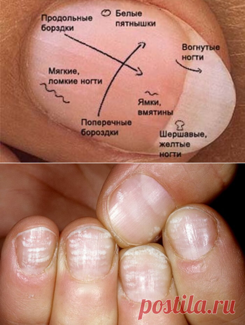 По ногтям определить человеком. Состояние здоровья по ногтям. Определить болезнь по ногтям. Болезни по ногтям на ногах таблица.