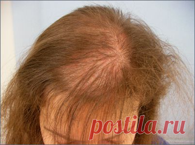 ОБЛЫСЕНИЕ ПО МУЖСКОМУ ТИПУ...??? ЛЕЧИМ...