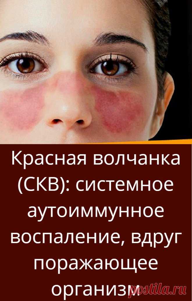 Красная волчанка (СКВ): системное аутоиммунное воспаление, вдруг пора ...