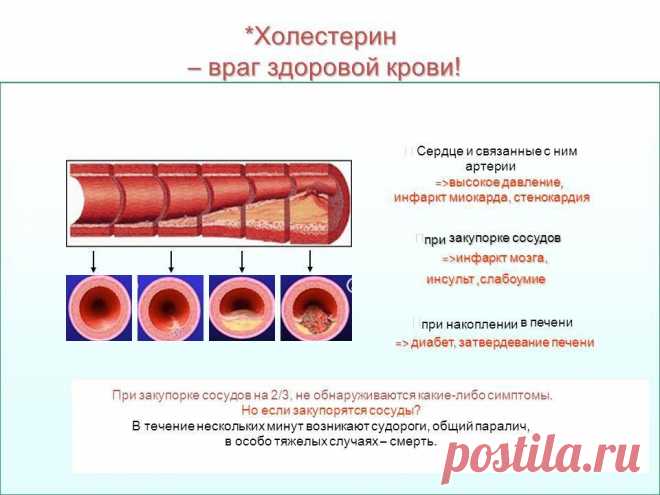 Как Оказалось, Очистить Сосуды От Холестерина Можно Без Врачей И Таблеток