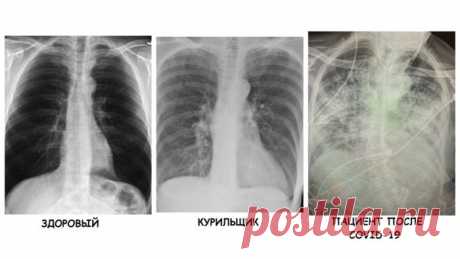 Врач сравнила рентген-снимки здорового, курильщика и больного коронавирусной инфекцией