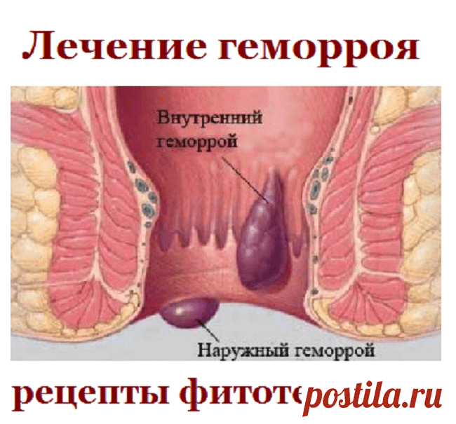 Лечение геморроя, рецепты фитотерапии | Советы целительницы