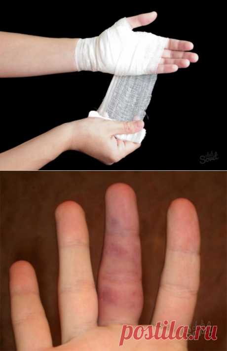 Как лечить ушиб пальца?