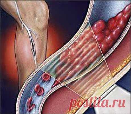 Предупреждаем тромбофлебит | Друг пенсионера
У моей мамы был сильный варикоз (варикозное расширение вен). На но­гах вены были набрякшие, очень бо­лели, набухали в узлы, от поднятия тя­жестей или долгого си­дения в одной позе час­то начинали беспокоить так, что мама не удер­живалась от слез. Она не могла подолгу хо­дить, быстро уставала.