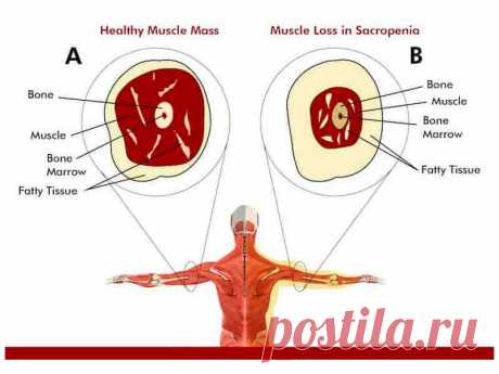 Это нужно знать, чтобы не дать себе засохнуть. Саркопения Саркопенией называют возрастную атрофическую дегенеративную потерю мышечной массы и силы. В основном, эта патология развивается у людей после пятидесятилетия. Примерно у одного из десяти человек после 50 лет, возникают симптомы мышечной дегенерации. Это во многом объясняет падения и переломы у людей пожилого возраста.