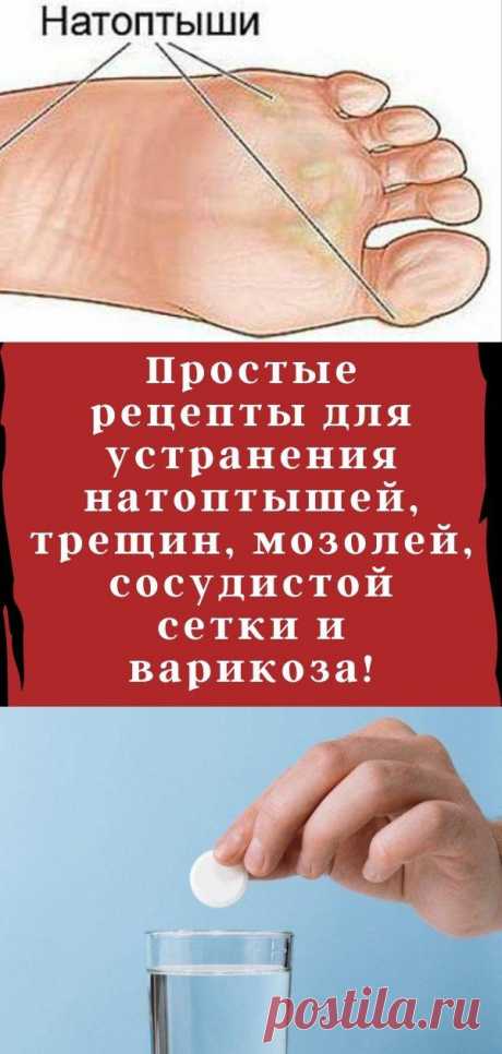 Простые рецепты для устранения натоптышей, трещин, мозолей, сосудистой сетки и варикоза!